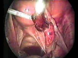 Salpingotomy for unruptured Ectopic pregnancy