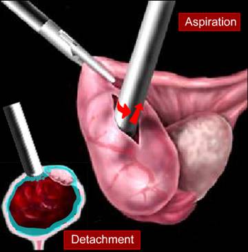 Suction of trophoblast for unruptured Ectopic pregnancy