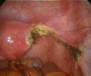 Salpingectomy