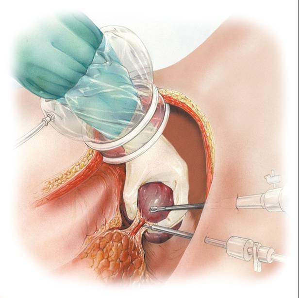 Hand Assisted Laparoscopic Surgery