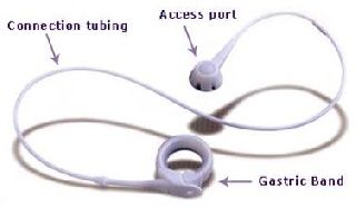 लेप्रोस्कोपिक गैस्ट्रिक बैंडिंग के 40% मरीजों को समस्याएं होती हैं।