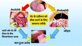 लैपरोस्कोपिक सर्जरी के दौरान अडीशन परोक्षण