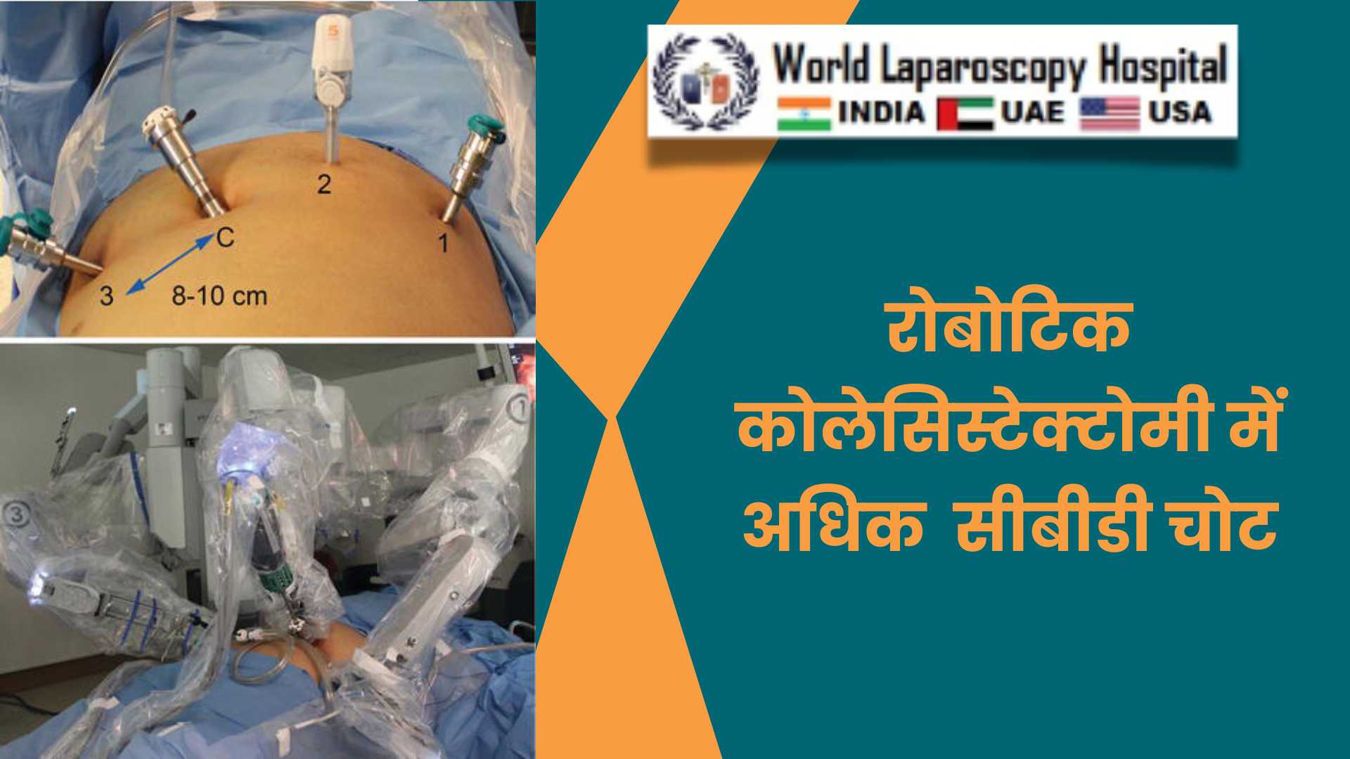 रोबोटिक बनाम लेप्रोस्कोपिक कोलेसिस्टेक्टॉमी में उच्च सीबीडी चोट