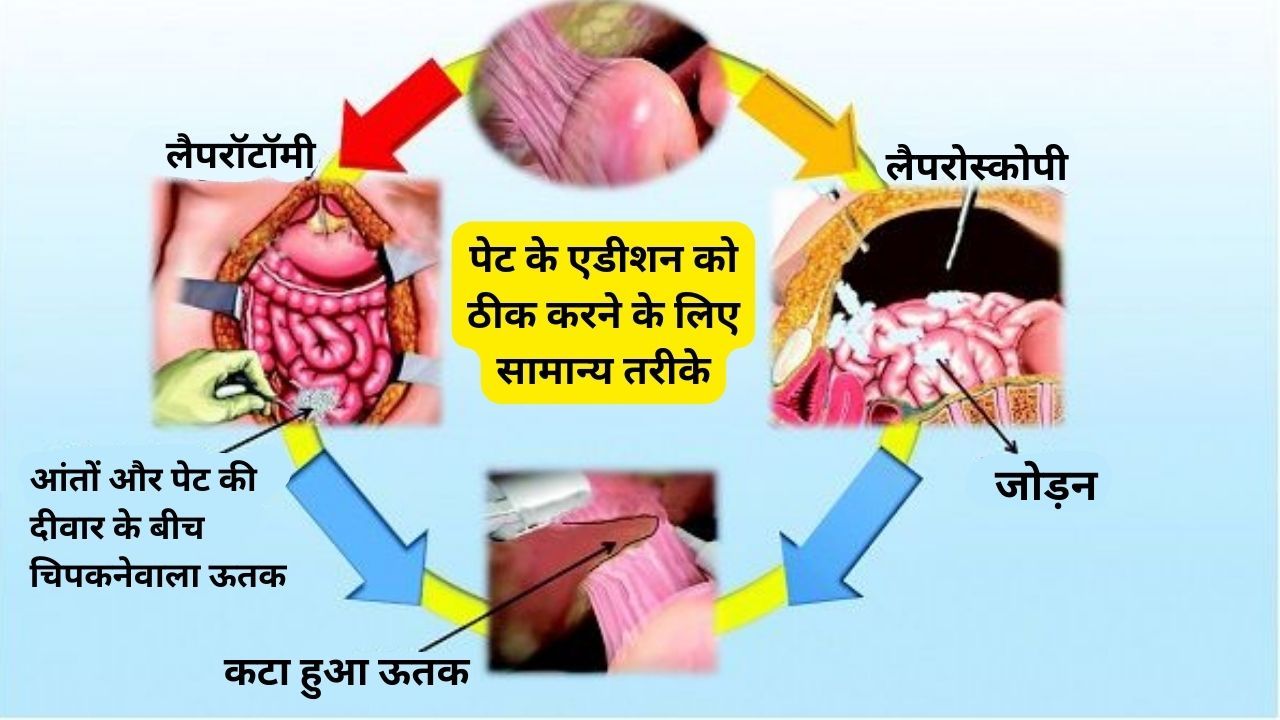 लैपरोस्कोपिक सर्जरी के दौरान अडीशन परोक्षण