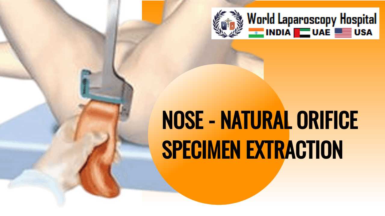 NOSE - प्राकृतिक छिद्र नमूना निष्कर्षण