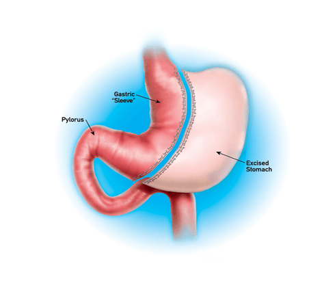 Laparoscopic Sleeve Gastrectomy