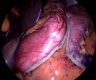 how-to-perform-laparoscopic-sleeve-gastr