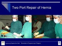 Two Port Laparoscopic Repair of Ventral Hernia