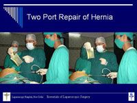 Two Port Laparoscopic Repair of Ventral Hernia