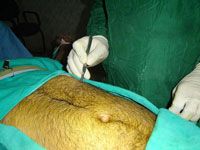 Two Port Laparoscopic Repair of Ventral Hernia