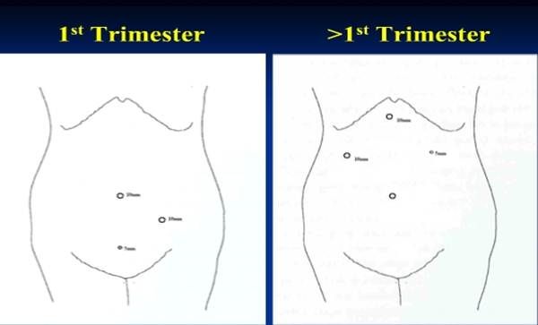 laparoscopy for acute abdomen in pregnancy
