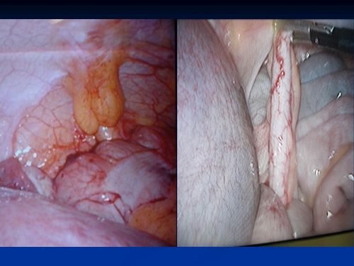 laparoscopy for acute abdomen in pregnancy