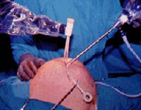 laparoscopy for acute abdomen in pregnancy
