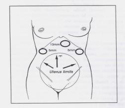 laparoscopy for acute abdomen in pregnancy