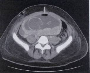 Pneumoamnion con subcutaneous emphysema