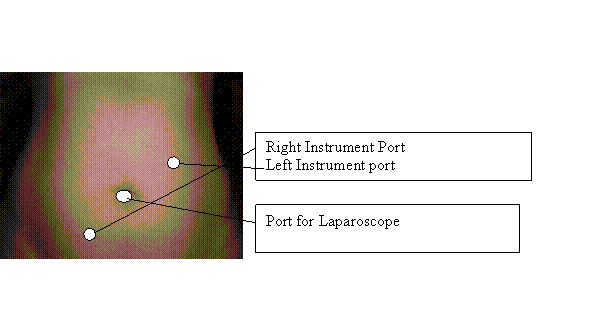 Port position for Laparoscopic Oophorectomy