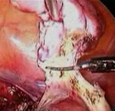 Dissection at the level of infundibulo-pelvic ligament
