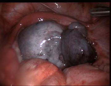 Torsion of ovary