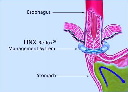 Linx Device