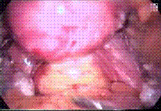 Colpotomy