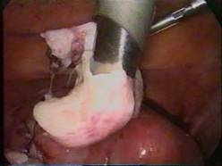 Colpotomy