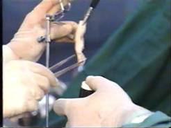 Colpotomy