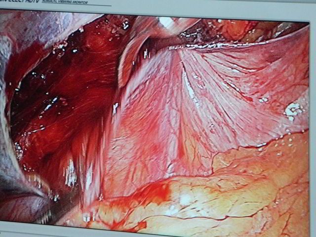 Advanced Laparoscopic Training