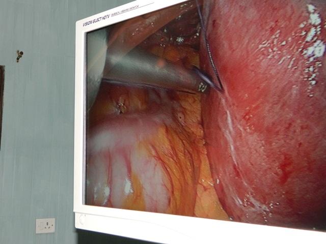Hands On Laparoscopic Training