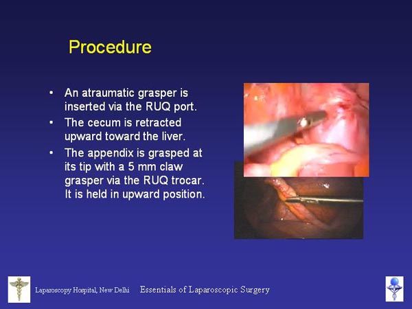 Laparoscopic Pictures From World Laparoscopy Hospital