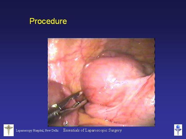 Laparoscopic Pictures From World Laparoscopy Hospital