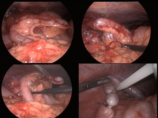 Laparoscopic Pictures From World Laparoscopy Hospital