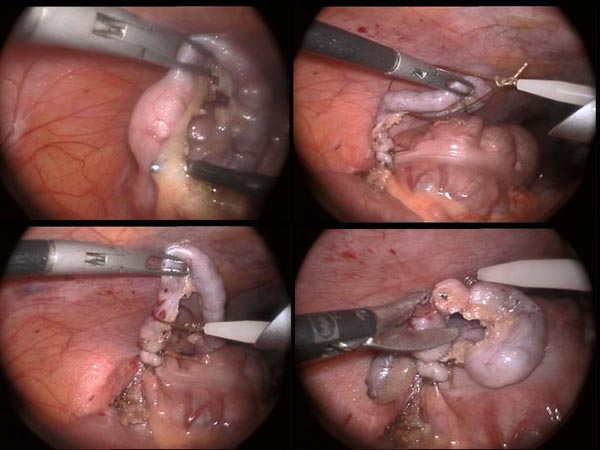 Laparoscopic Pictures From World Laparoscopy Hospital