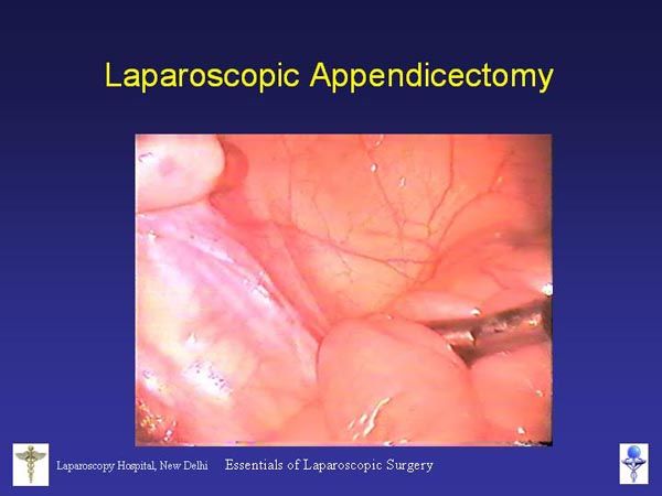 Laparoscopic Pictures From World Laparoscopy Hospital