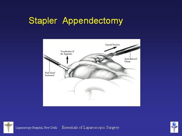 Laparoscopic Pictures From World Laparoscopy Hospital