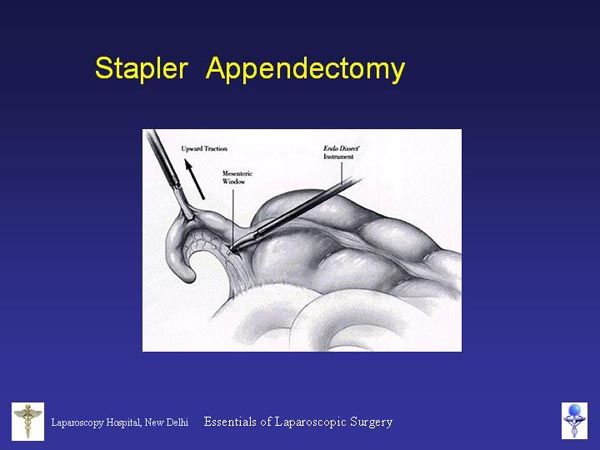 Laparoscopic Pictures From World Laparoscopy Hospital