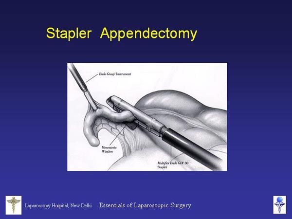 Laparoscopic Pictures From World Laparoscopy Hospital