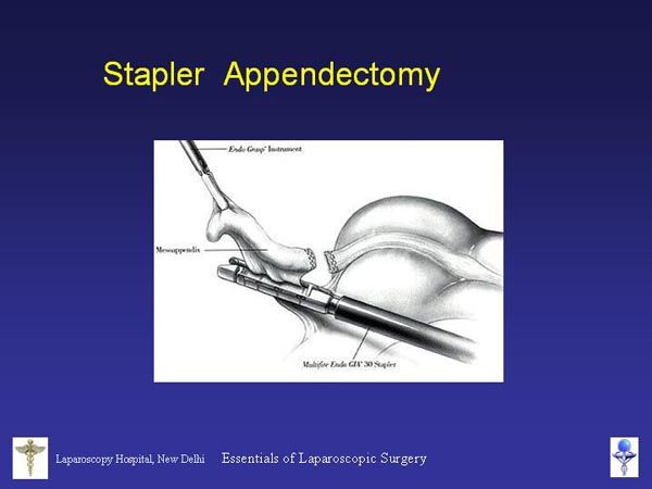 Laparoscopic Pictures From World Laparoscopy Hospital