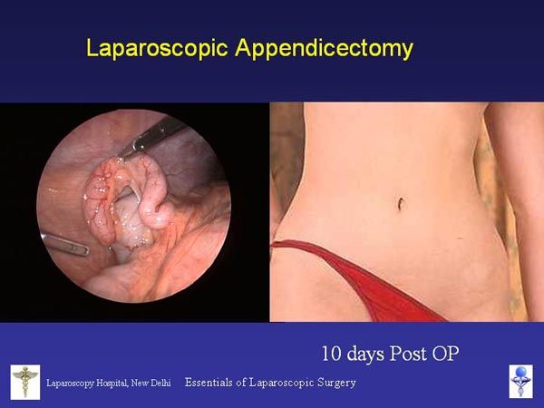 Laparoscopic Pictures From World Laparoscopy Hospital