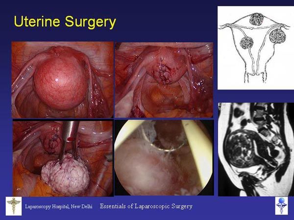 Laparoscopic Pictures From World Laparoscopy Hospital