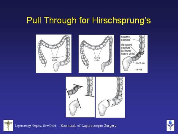 Laparoscopic Pictures From World Laparoscopy Hospital