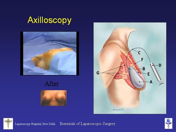 Laparoscopic Pictures From World Laparoscopy Hospital