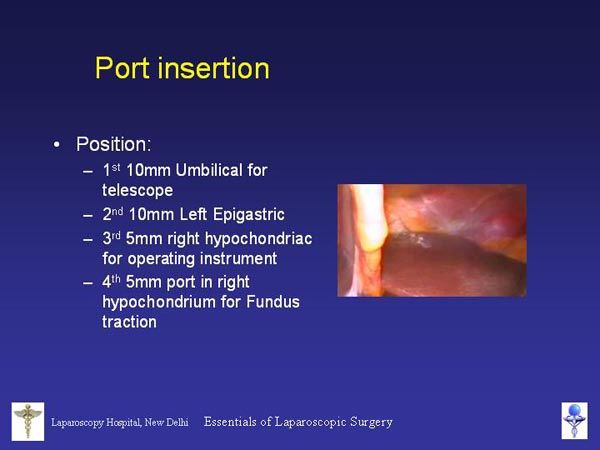 Laparoscopic Pictures From World Laparoscopy Hospital