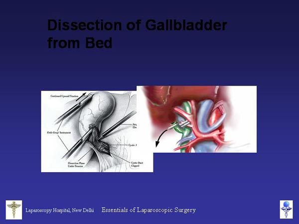 Laparoscopic Pictures From World Laparoscopy Hospital