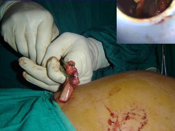 Laparoscopic Pictures From World Laparoscopy Hospital