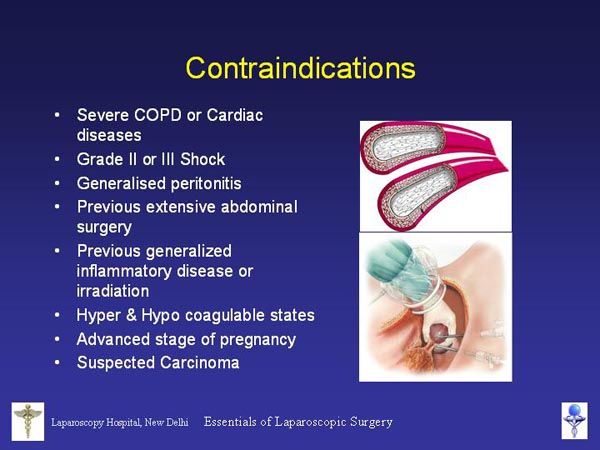 Laparoscopic Pictures From World Laparoscopy Hospital