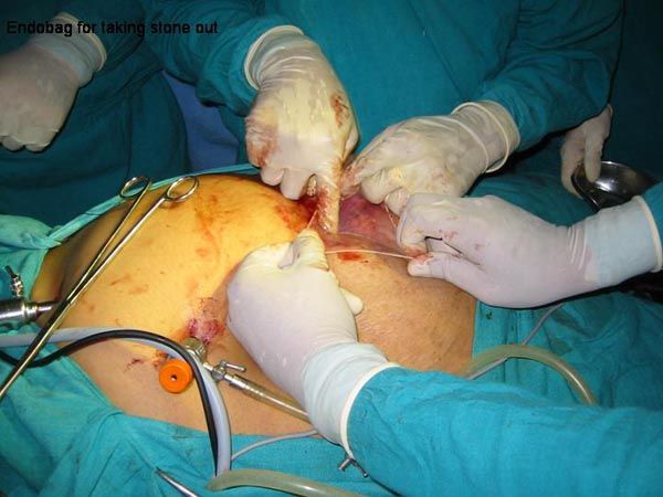 Laparoscopic Pictures From World Laparoscopy Hospital