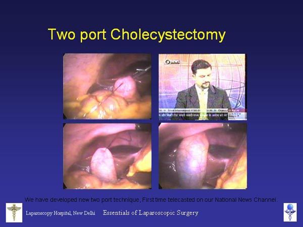 Laparoscopic Pictures From World Laparoscopy Hospital