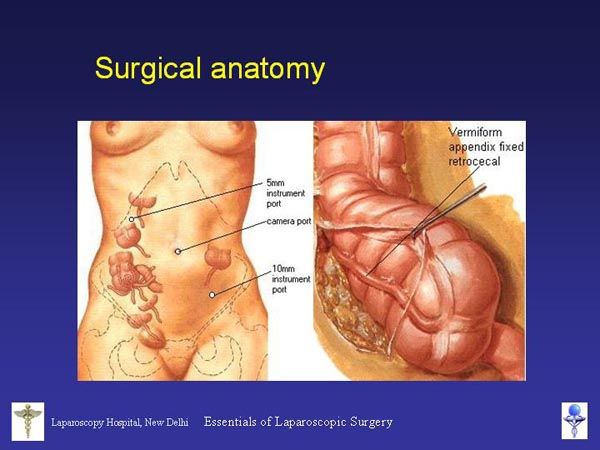 Laparoscopic Pictures From World Laparoscopy Hospital