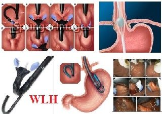 Plicator Endoscopic Treatment for Gastroesophageal Reflux ...