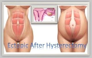 Ectopic pregnancy in tube two years after supracervical hysterectomy